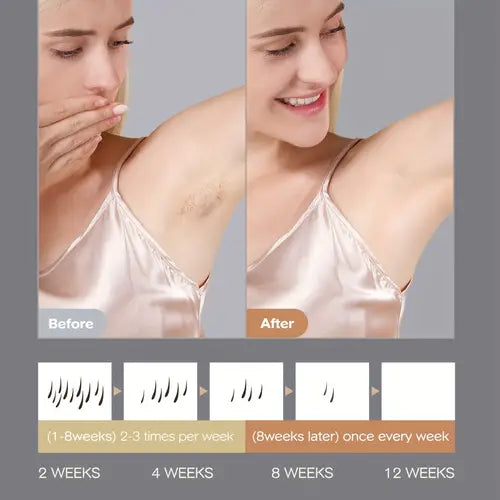 9-Mode Sarlisi Laser Hair Removal